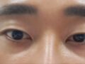 Review of Director Do Eon-rok's Under-eye Fat Repositioning