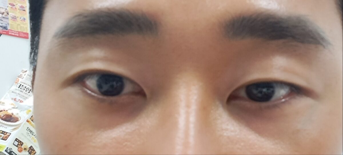 都彦禄院长  眼底脂肪重排  术后反馈