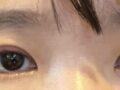 都彦禄院长  全切双眼皮+上眼角+提肌  术后反馈