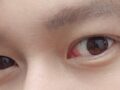 Eyelid surgery and eye shape correction
