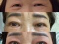 金洪振院长   双眼皮手术（中年整形） 术后反馈