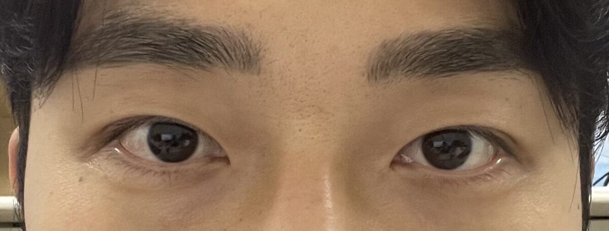 都彦禄院长 自然粘合+非切开式提肌矫正术