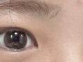 Director Do Won-rok + Double Eyelid Suture (Revision)