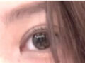 Revision surgery (natural adhesion + upper eyelid lift) with Director Do Eon-rok