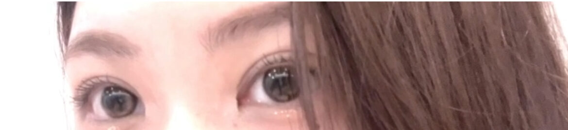 都彦禄医生主刀的修复手术（自然粘合+上眼角）