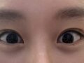 全切双眼皮  术后反馈（都彦禄院长）