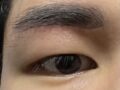 都彦禄院长- 切眉提升 术后反馈