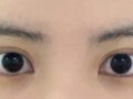 One and a half month review of Dr. Do Eon-rok's double eyelid surgery + upper eyelid lift