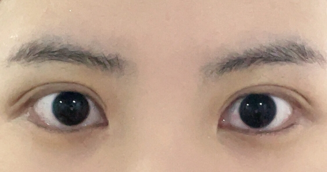 都彦禄医生双眼皮手术+开上眼角一个半月后的复查