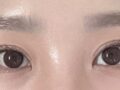 Director Do Eon-rok's eye revision surgery