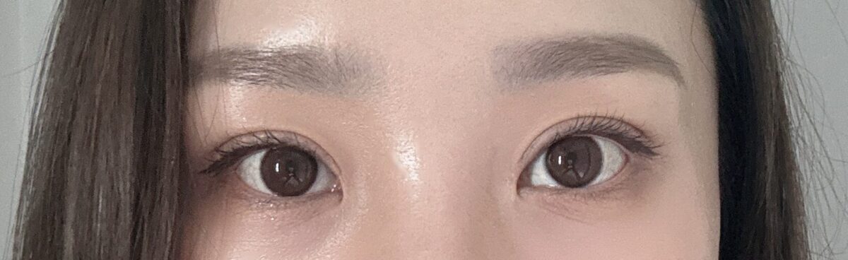 都彦禄院长   双眼皮修复