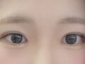 Double eyelid revision (incision), upper eyelid lift (revision), and eye shape correction reviews