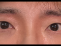 キム・ホンジン院長は眉毛の下の巨像手術の後期です。
