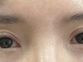 双眼皮修复+上眼角+提肌