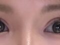 Double Eyelid Incision + Eye Shape Correction - Director Do Eon-rok
