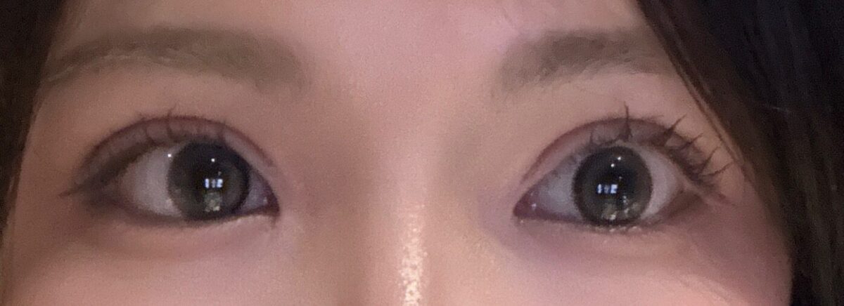 切开双眼皮+提肌 - 都彦禄院长