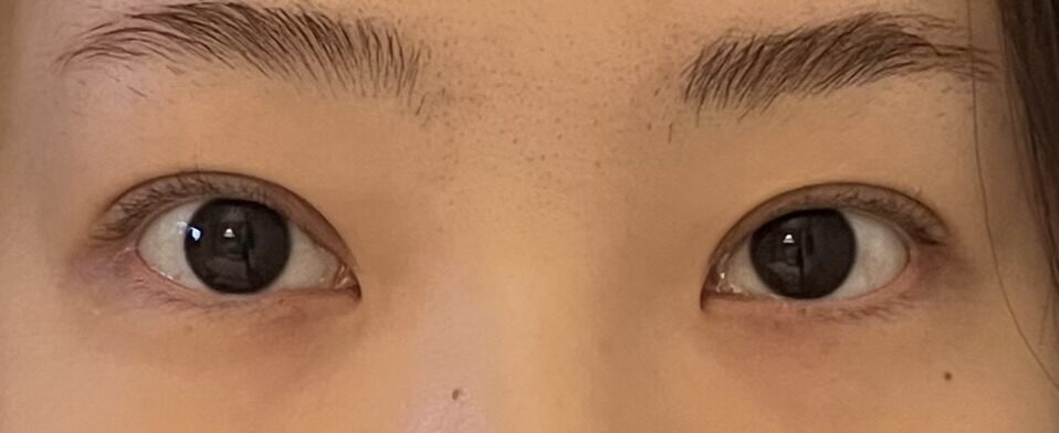 对金洪振医生自然粘连埋线 开上眼角手术的评价
