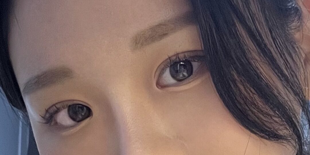 一毫米都医师的自然粘合+上眼睑提升手术。