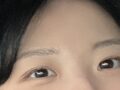 一毫米(XNUMXmm)整形 都彦禄院长/ 埋线双眼皮  术后反馈