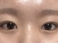 一毫米  自然粘连双眼皮