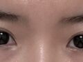 Dr. Do Eon-rok's Eye Revision Surgery Review