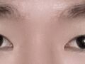 Dr. Do Eon-rok / Incisional Double Eyelid Surgery + Eyelid Correction / 30s / Male / Before & After Photos / 3 Months