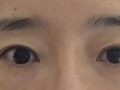 真实术后反馈