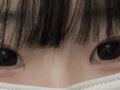 1mm non-incisional double eyelid surgery epicanthoplasty