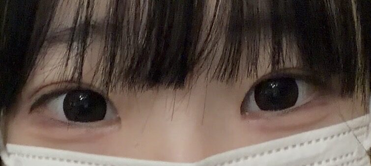 一毫米  埋线双眼皮+前眼角