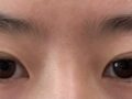 Natural Adhesion Double Eyelid Surgery & Eyelid Correction Review