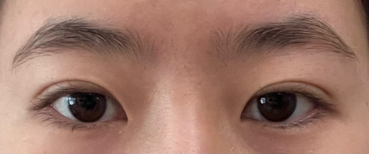 自然粘连双眼皮+提肌  术后反馈