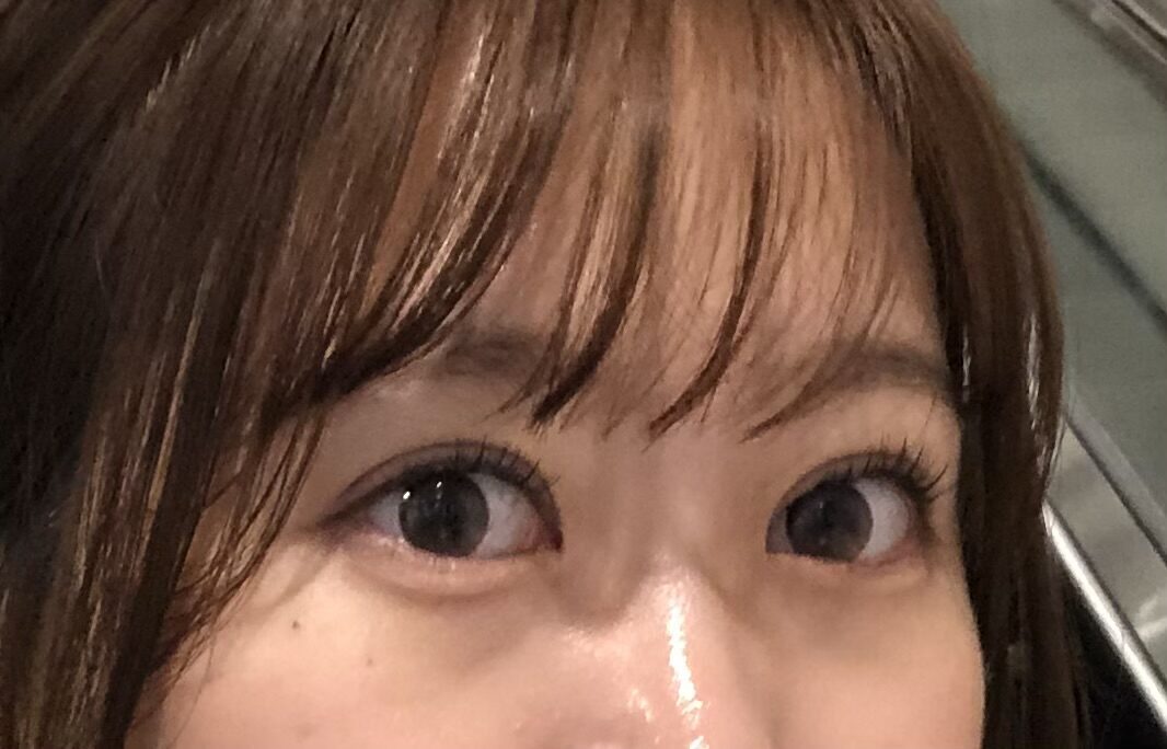 一毫米  自然粘连  术后反馈