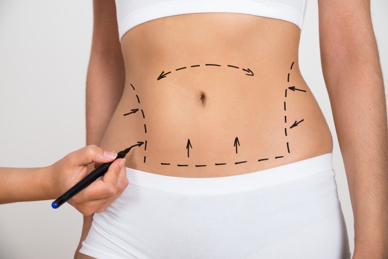 Sau hút mỡ, có cần thiết phải mặc quần áo định hình không? (Bệnh viện thẩm mỹ 1mm)