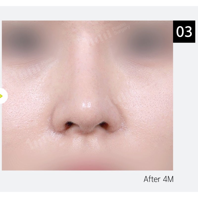 Alar Reduction? Nose Surgery by Type, Including Wide Nostril Correction 사진 12