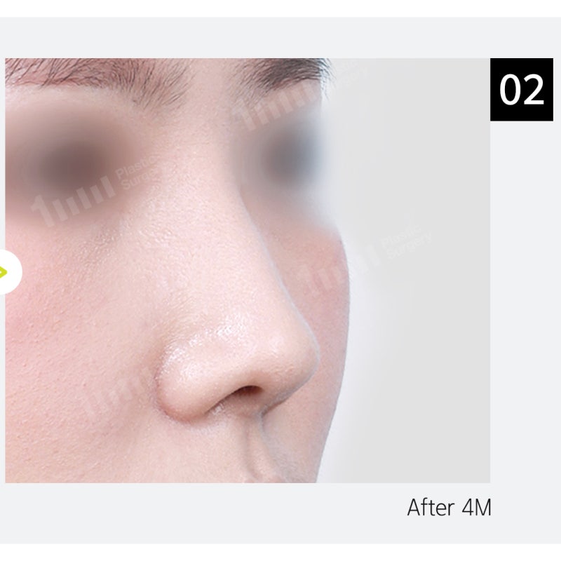 Alar Reduction? Nose Surgery by Type, Including Wide Nostril Correction 사진 9
