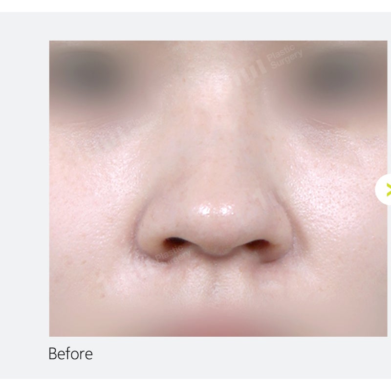 Alar Reduction? Nose Surgery by Type, Including Wide Nostril Correction 사진 11