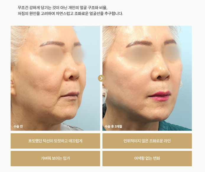 1mm整形外科 FaceFit迷你拉皮 사진 5