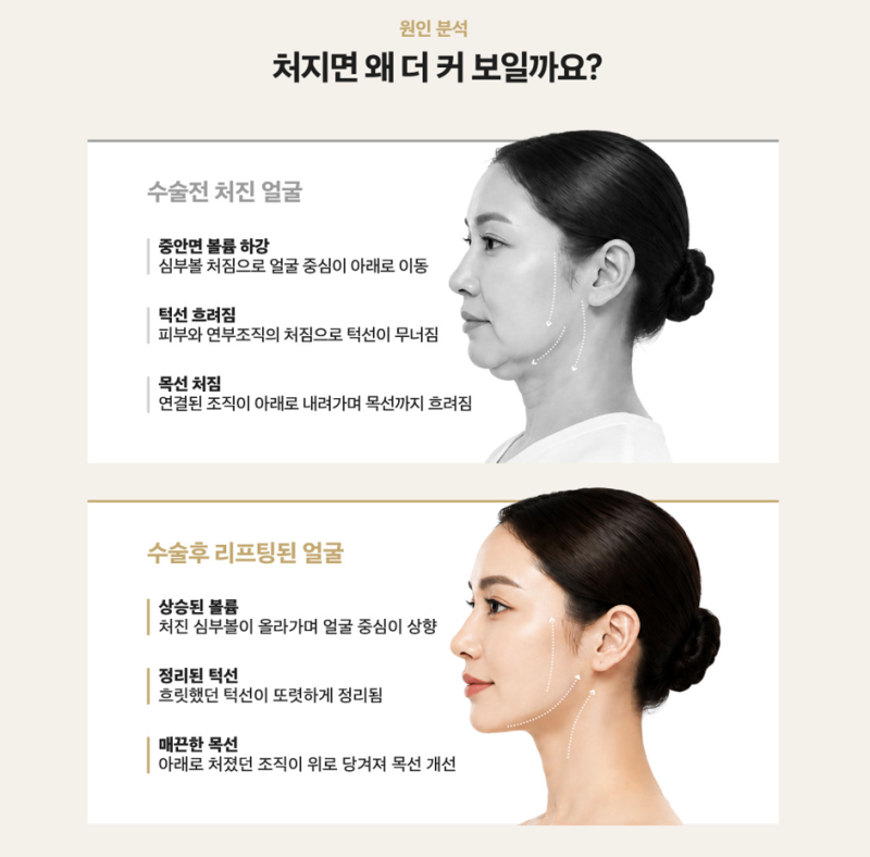 1mm整形外科 FaceFit迷你拉皮 사진 2