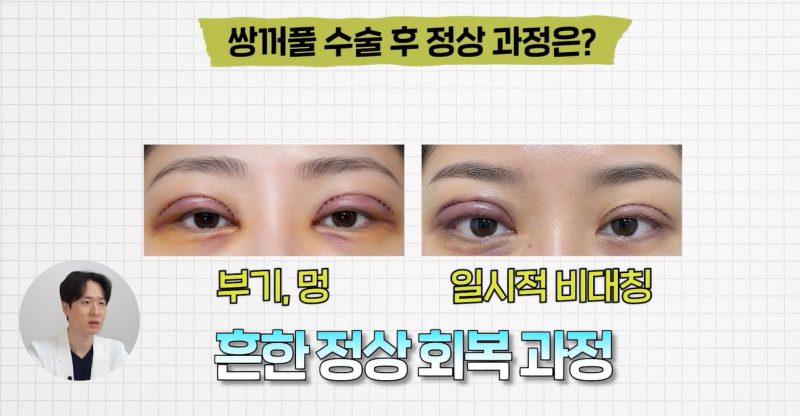 Swelling, Bruising, Asymmetry After Double Eyelid Surgery: Normal Recovery or Side Effect? 1mm Plastic Surgery 사진 2