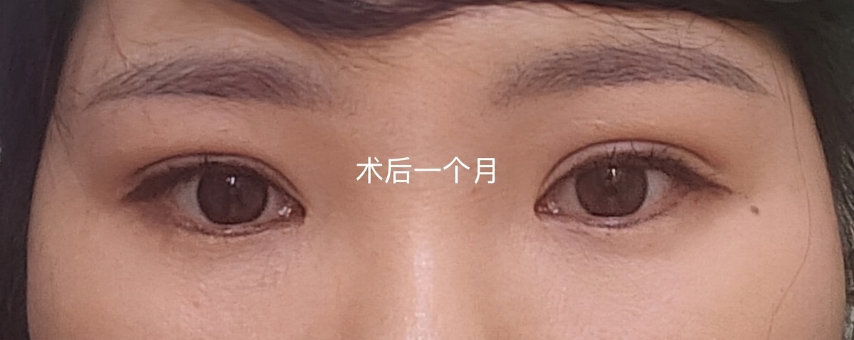 都彦禄 院长/切开式双眼皮修复手术