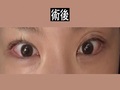 都彥祿醫師的雙眼皮手術，重新矯正眼型